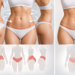 360 Body Lift vs Traditional Tummy Tuck Differences